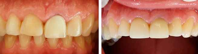 Preencimento labial Preencimento labial