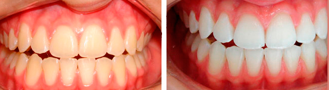 Rinomodelação Rinomodelação