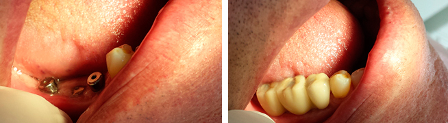 Bichectomia Bichectomia