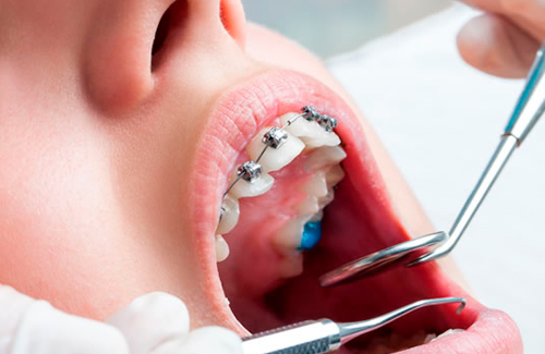 Bichectomia Bichectomia